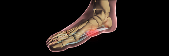 Plantar Fasciitis Header Image